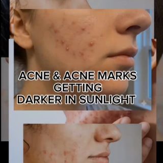 UV rays seeing acne marks like free real estate 😭Good thing SPF is FREE this summer 😌Book your order now
www.broadaesthetic.com#fyp #glowingskin #acnefree #clearskinjourney #summer